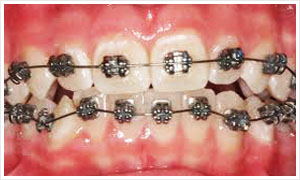 牙齒矯正器案例圖片
