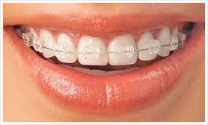 牙齒矯正器案例圖片